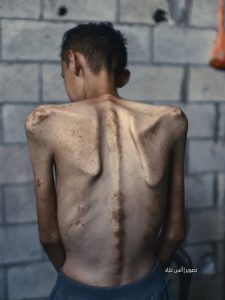 Potret Ahmed Alaa, Penderita Penyakit Celiac di Gaza