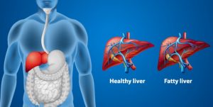 Perkembangan Penyakit Hati Berlemak Nonalkohol