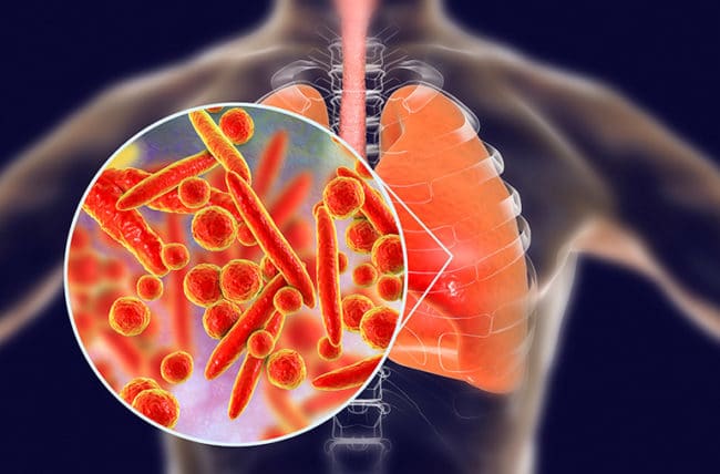 Inilah Gejala Mycoplasma Pneumonia yang Harus Diketahui