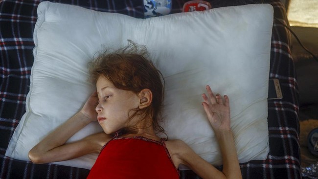 Dunia Tutup Mata saat Ribuan Anak-anak Gaza Kekurangan Gizi