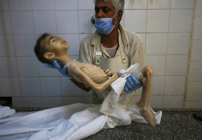 Malnutrisi Parah Anak Gaza