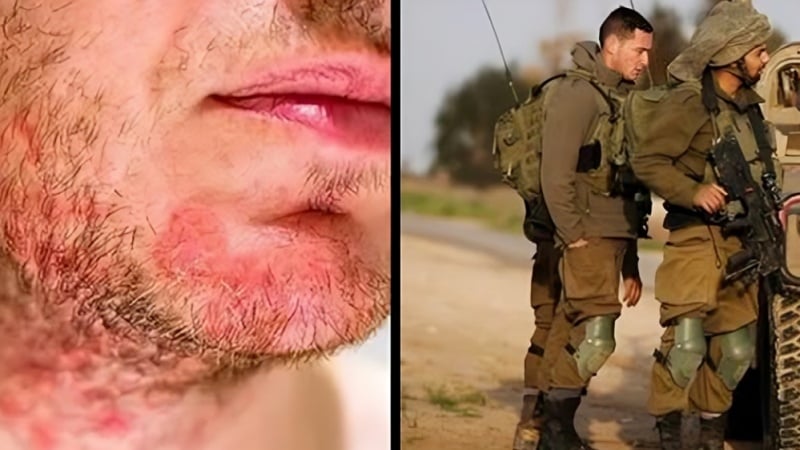 Penyakit zionis