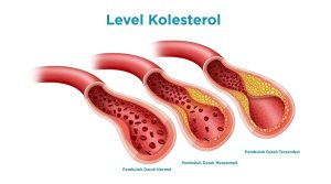 Kolesterol Naik